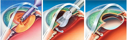refacerea vederii după facoemulsificarea cataractei)