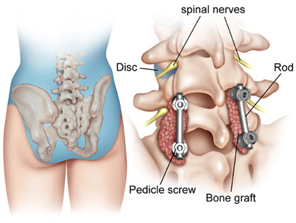 varicoza de la hernia coloanei vertebrale
