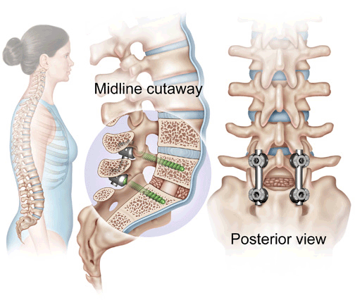coloanei vertebrale jurnal de durere după dureri de artroplastie la genunchi în