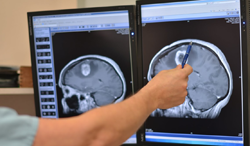 tumori cerebrale și pierderea vederii