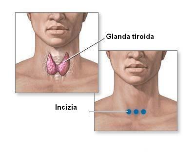 Nodulii Glandei Tiroide Cand Trebuie Operați Medpark
