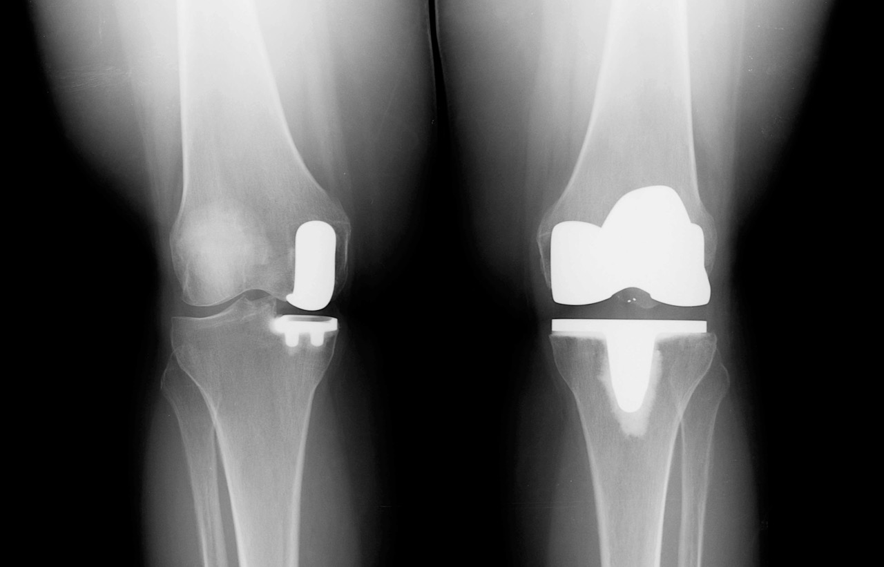 Замена сустава осложнения. Тотальное эндопротезирование коленного сустава рентген. Эндопротез коленного сустава рентген. Одномыщелковое эндопротезирование коленного рентген. Гонартроз коленного сустава эндопротез.